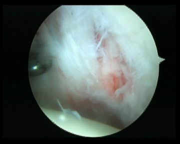 Arthroscopy Anterior Sublabral Foramen